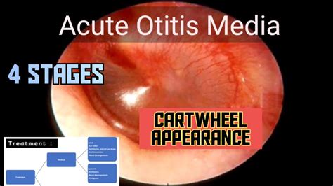 Acute Otitis Media| Etiology | Signs | Stages | Treatment | ENT | MEDU ...