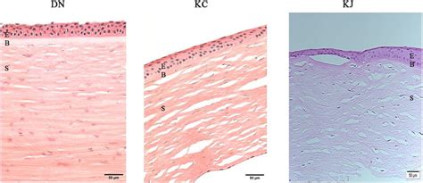 Histology of patient and donor cornea sections. The figure shows ...