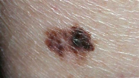 Raised Skin Bumps: Pictures, Types, Causes, and Treatment