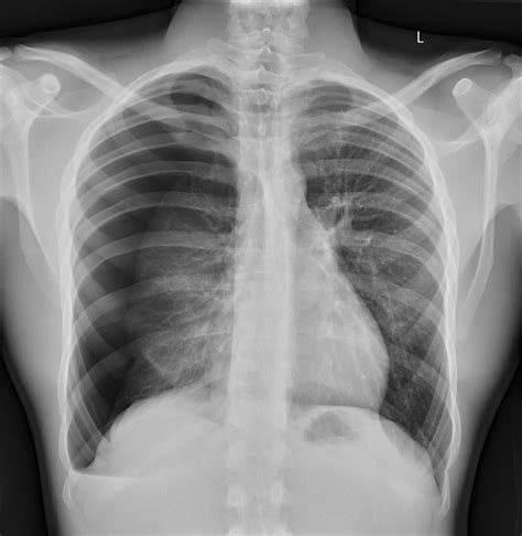 Pneumothorax Chest X Ray