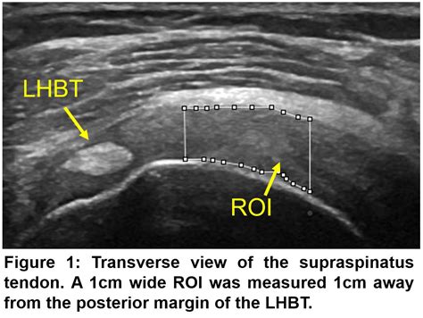 Correlation of Tendon Degeneration and Quantitative Ultrasound Measurements