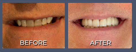 Full Mouth Reconstruction in Sunny Isles Beach, Cost of Dental Restoration