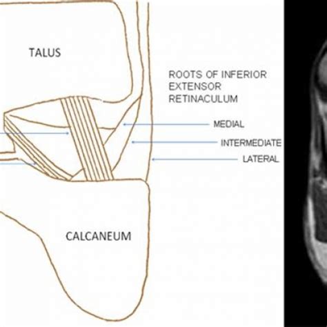 Sinus Tarsi Anatomy - Anatomical Charts & Posters