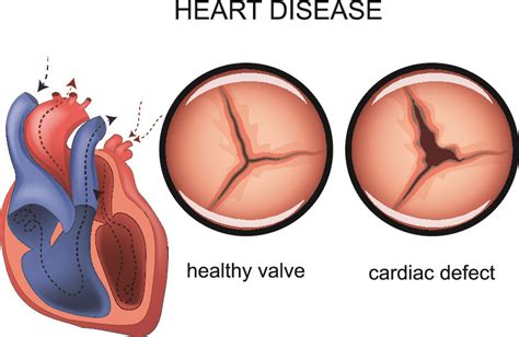 Mitral Valve Disease, Symptoms, and Treatment - Pulse Cardiology