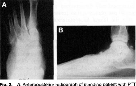 Talipes Calcaneovalgus | Semantic Scholar