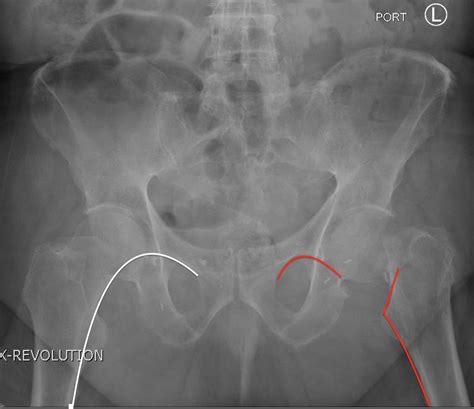 Femoral Neck Fracture, AP Xray, Annotated. JETem 2016 - JETem