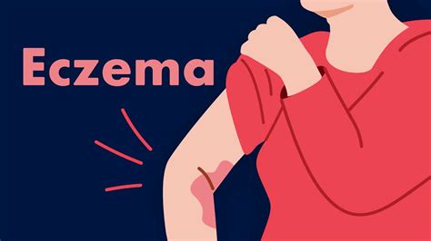 Eczema Symptoms and Management | Ausmed