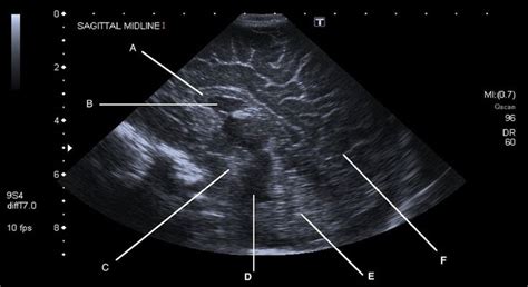 Try and identify the structures labelled A-F on this normal midline sagittal cranial ultrasound ...