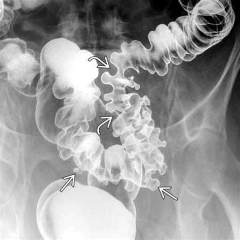 Diverticulitis X Ray