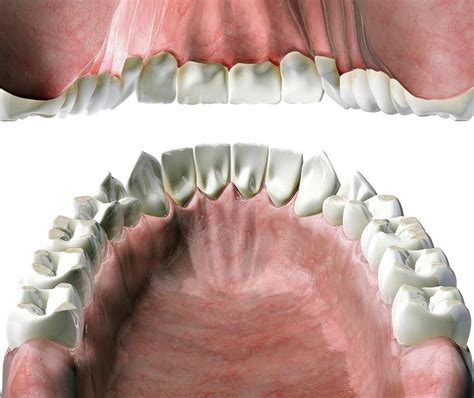 Dental Acid Erosion Photograph by Claus Lunau/science Photo Library