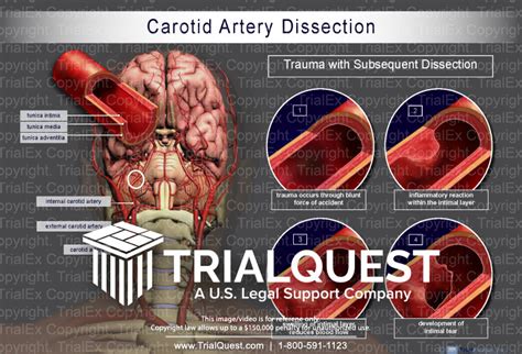 Carotid Artery Dissection - TrialQuest Inc.