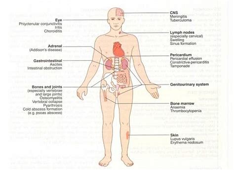 Miliary Tuberculosis (TB) Symptoms, Causes, Radiology, Diagnosis & Differential Diagnosis ...