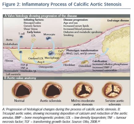 Calcific Aortic Valve Disease: Molecular Mechanisms and Therapeutic Approaches | Radcliffe ...