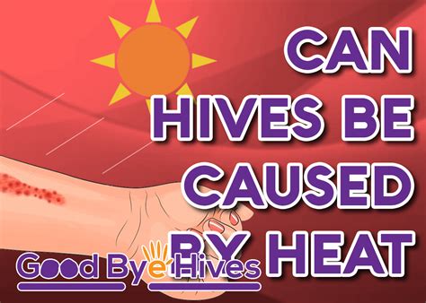 Can Hives Be Caused by Heat? | Hives causes, Hives, Urticaria