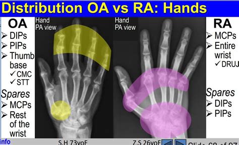 comparison of osteoarthritis and rheumatoid arthritis involvement of the hands | Osteoarthritis ...