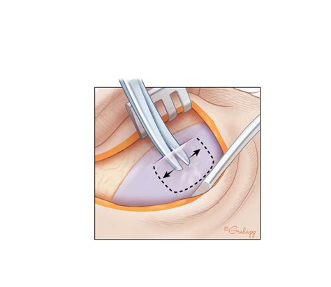 Fascia Harvesting – Oto Surgery Atlas