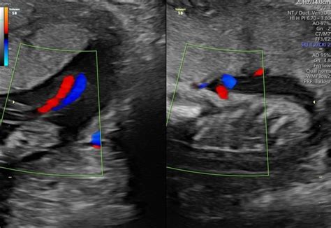 Umbilical Artery Ultrasound