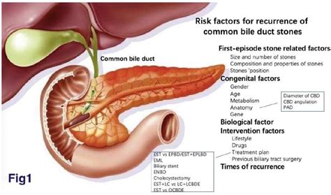 Figure 1 from Advances in Risk Factors for Recurrence of Common Bile ...