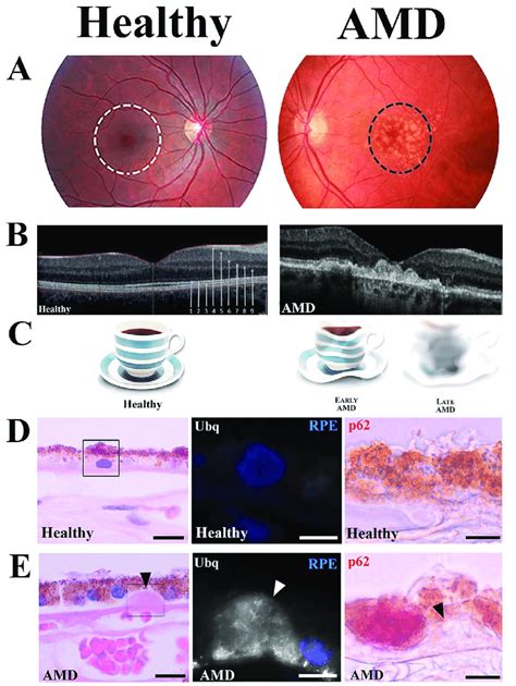 Macular Degeneration Symptoms