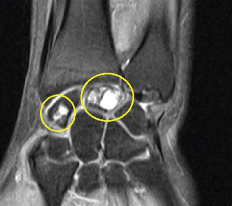 MRI of the left wrist showing IGC (from (a) to (b)) in the scaphoid,... | Download Scientific ...