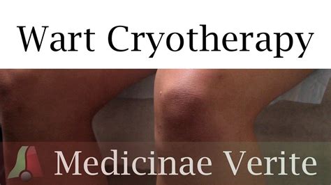 wart cryotherapy | Auburn Medical Group - YouTube