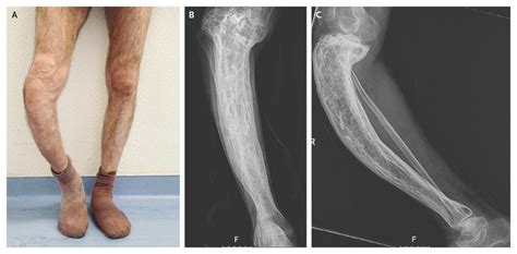 Symptoms And Causes Of Paget's Disease Of Bones