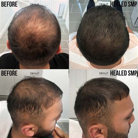 AMAZING RESULT | Scalp Micropigmentation (SMP) Before and After | Birmingham UK