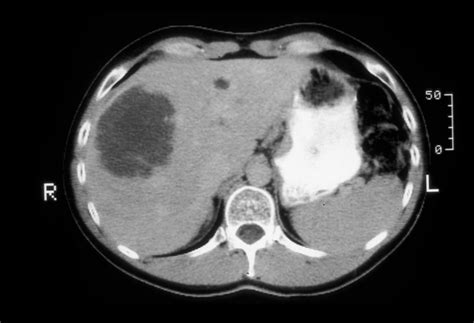 Liver Cancer: Liver Cancer Ct Scan