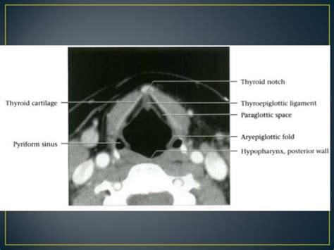 Larynx anatomy ct and mri