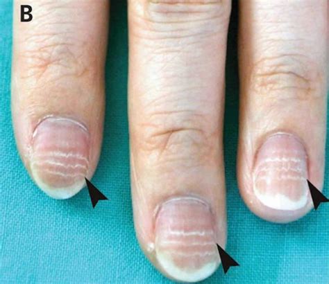 Mees lines fingernails causes, symptoms & treatment