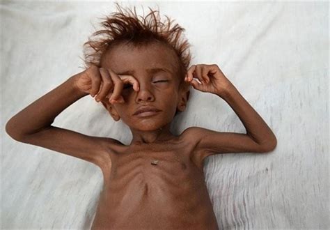 UNICEF: 92% of Babies in Yemen Are Underweight at Birth - World news - Tasnim News Agency