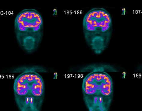 brain-pet-scan-708x556-2x