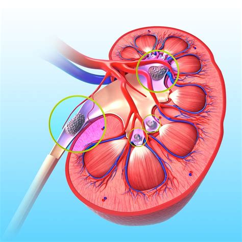 Author Insight: Ultrasonography versus CT for suspected nephrolithiasis | NEJM