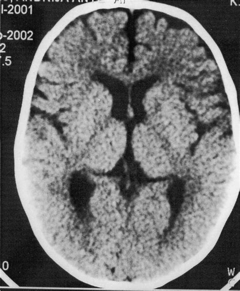 CT brain scanning demostrates severe diffuse cerebral atrophy ...