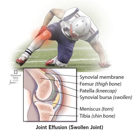 Joint Effusion (Swollen Joint): Symptoms, Causes, and Treatment