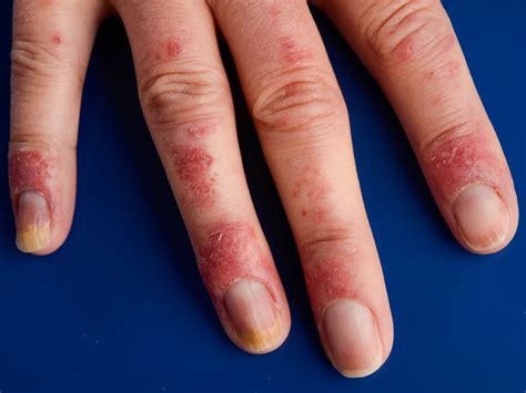 chilblains lupus - pictures, photos