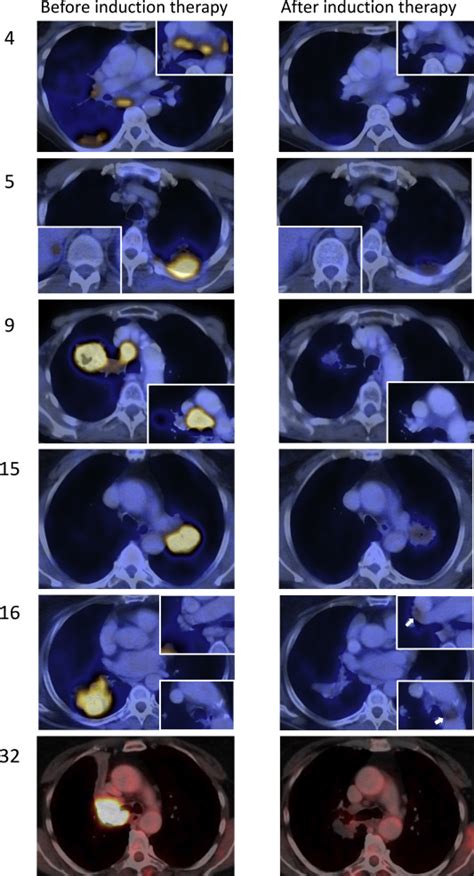 Prospective trial of immuno(chemo)therapy before resection, definitive ...