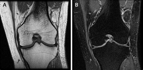 Anterior cruciate ligament (ACL) mucoid degeneration in a 45-year-old... | Download Scientific ...