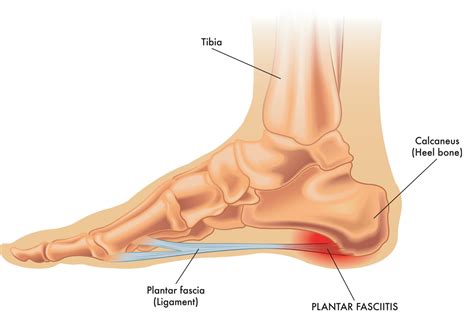 Plantar Fasciitis Symptoms, Causes & Treatments | Advanced Surgery Center