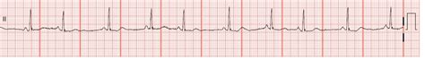 Float Nurse: EKG Rhythm Strips 27: Atrial Rhythms