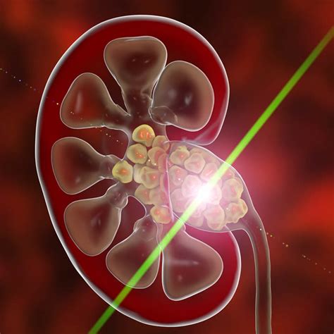 Laser Lithotripsy: Laser Treatment of Kidney Stones