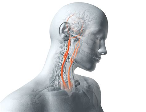 Carotid Artery Surgery: Could It Give You a Stroke? | Reader's Digest