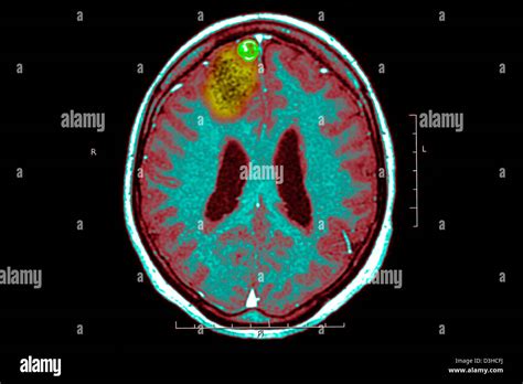 EPILEPSY, MRI Stock Photo - Alamy