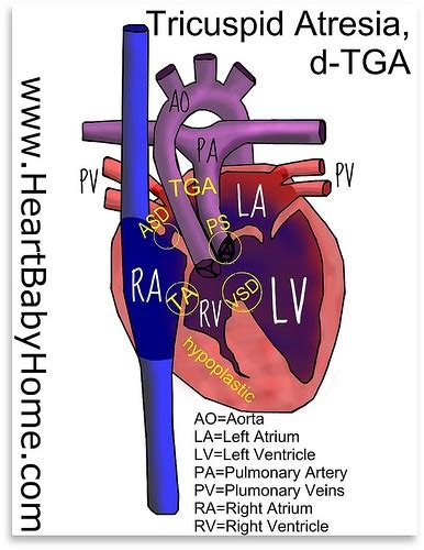 Tricuspid Atresia, d-TGA(DOLV) | Pediatric nursing, Neonatal nurse, Echocardiogram