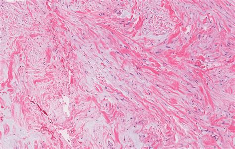 Fibroma Histology