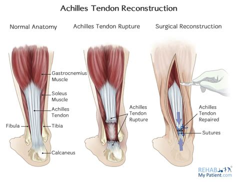 Achilles Tendon Rupture | Rehab My Patient