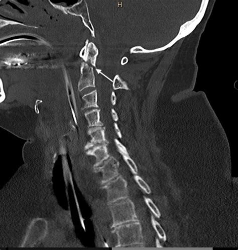 Cureus | Spinal Cord Transection in a Type II Odontoid Fracture From a ...