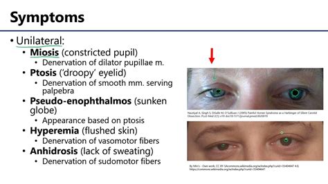 Horner's Syndrome LO4 - M1 Anatomy Learning Objectives - YouTube