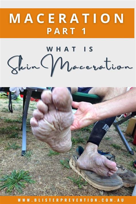 Maceration Part 1: What Is Skin Maceration - Blister Prevention Pro ...