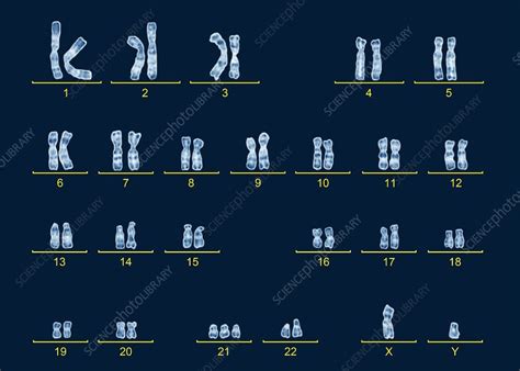 Male karyotype with Down's syndrome - Stock Image - C016/6749 - Science Photo Library